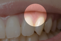 歯ぐきの再生